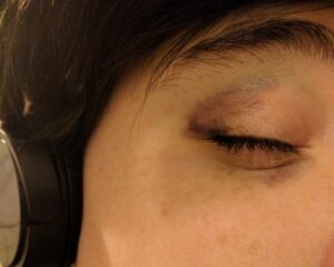 my very bruised right eye